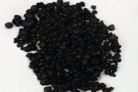 Hơn 400 viên sỏi trong túi mật người phụ nữ 44 tuổi
