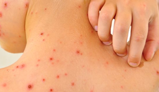 Gia tăng sốt xuất huyết do biến đổi khí hậu