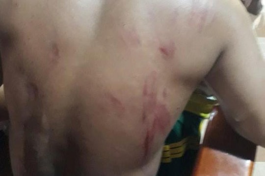 Cấp cứu người dân bị voi rừng tấn công