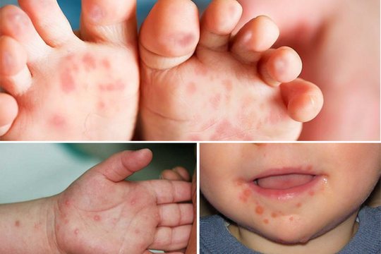 Trẻ mắc bệnh tay chân miệng nặng, biến chứng nguy hiểm: 6 khuyến cáo phòng chống bệnh cần biết