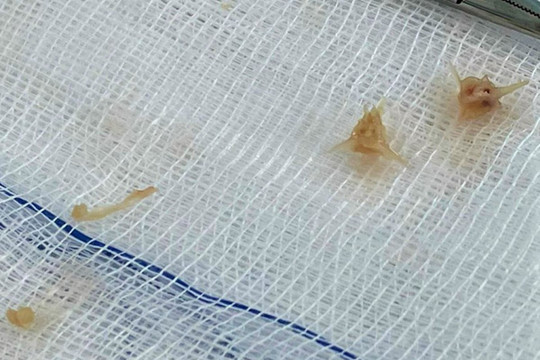 Bé gái thủng thực quản, nhiễm trùng do hóc xương lươn