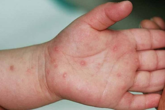 Nhiều trẻ mắc bệnh tay chân miệng nhập viện