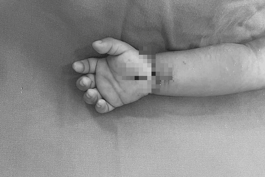 Bé trai 21 tháng tuổi nhập viện với bàn tay đứt lìa