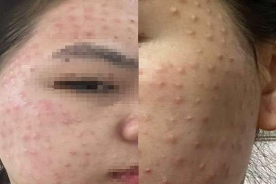 Mặt nổi u hạt sần sùi sau buổi tiêm chất "độc quyền" làm đẹp da miễn phí
