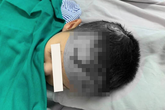 Đang chơi ở nhà, bé trai 3 tuổi bị chó cắn vào đầu