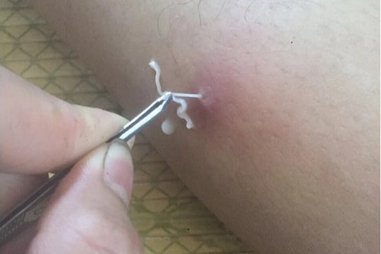 Ổ giun rồng được gắp ra từ khối sưng nề trên cơ thể