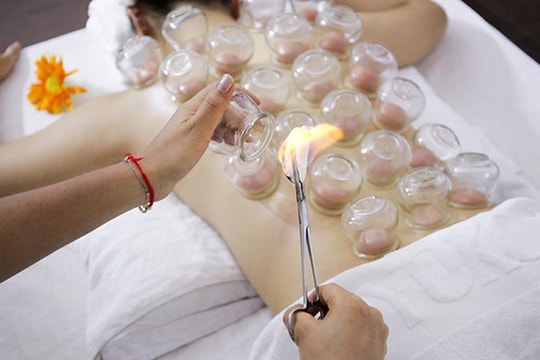 Nhập viện vì bỏng cồn sau khi giác hơi