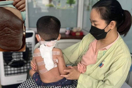 Bé trai có bớt đen khắp lưng, đi khám phát hiện bệnh hiếm gặp