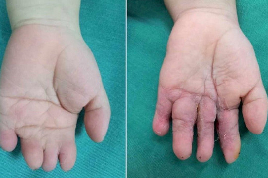 Phẫu thuật tách ngón tay dính bẩm sinh cho bệnh nhi 4 tuổi