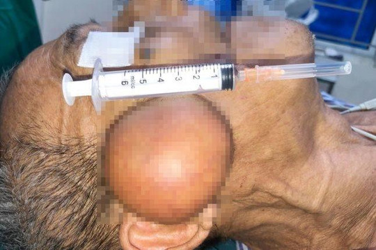 Cắt khối u nang lớn đeo bám trên mặt cụ ông hơn 10 năm