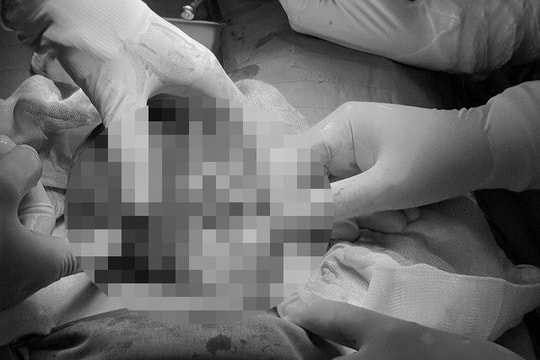 Cứu bé gái bị u buồng trứng xoắn, dị ứng với thuốc mê