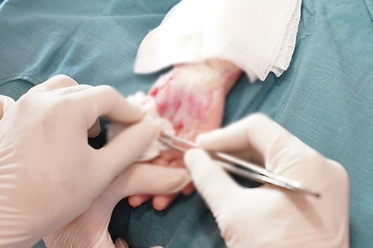 Liên tiếp trẻ bị bỏng nặng, hoại tử da tay do máy chạy bộ