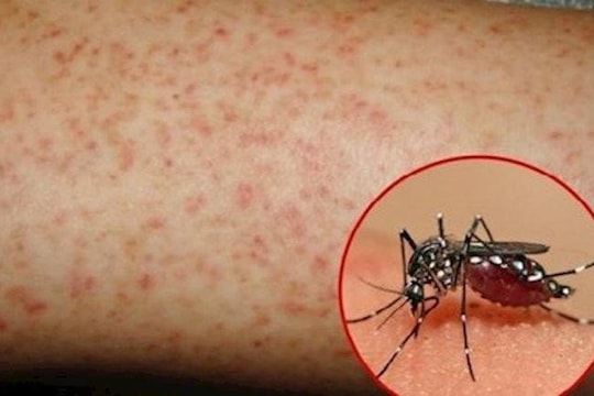 Tăng cường phòng, chống dịch bệnh mùa hè có thể bùng phát thành dịch lớn