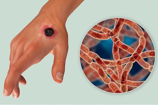 Bộ Y tế cập nhật thông tin mới nhất về tình hình dịch bệnh than trên người