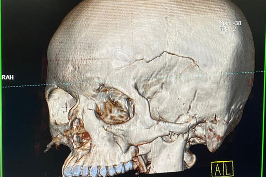 Bật báo động đỏ cứu bệnh nhân vỡ xương sọ, dập phổi từ Lào