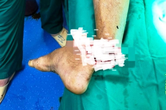Người đàn ông bị lưỡi cưa cắt đứt lìa bàn chân