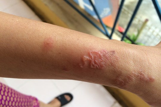 Ngứa, trầy xước hơn 10 năm mới phát hiện nhiễm giun đũa chó, mèo