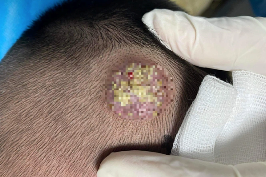 Nổi mụn mủ do nhiễm nấm từ thú cưng