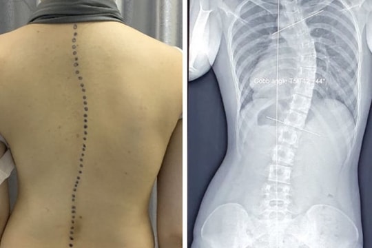 Cột sống cong chữ C, vẹo chữ S ở lứa tuổi học đường