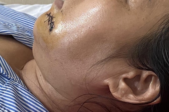 Nhắc nhở hàng xóm thả chó làm mất vệ sinh, người phụ nữ bị đánh nhập viện