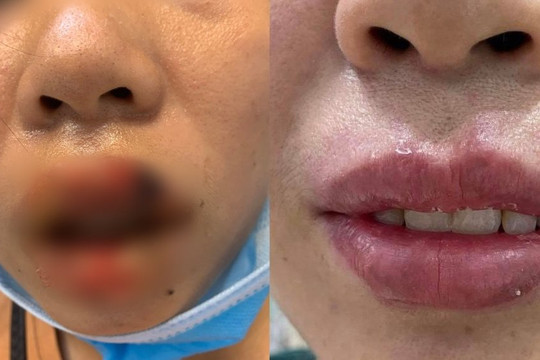 Môi sưng, mưng mủ sau khi phun xăm