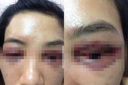 Suýt hỏng mắt vì làm mẫu cắt mí cho học viên ở spa