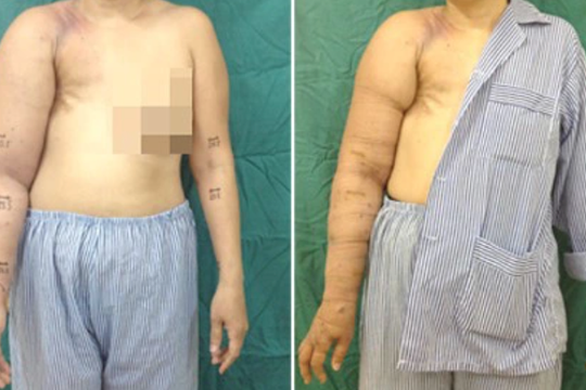 Phù tay voi, nỗi đau sau điều trị ung thư vú