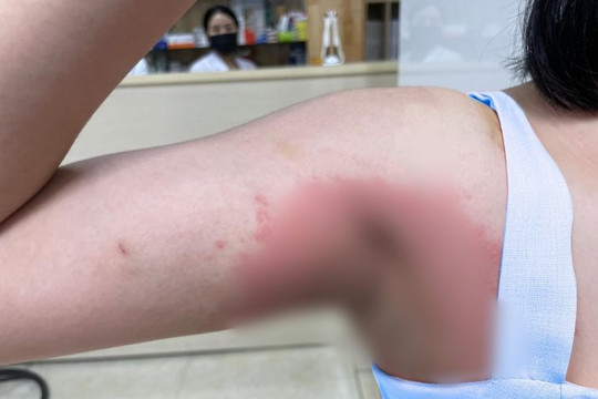 Nách nhiễm khuẩn sau liệu trình "lột da" 40 triệu đồng tại spa