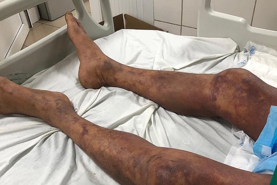 Sốc nhiễm khuẩn, suy đa tạng do ăn phải thịt lợn ốm