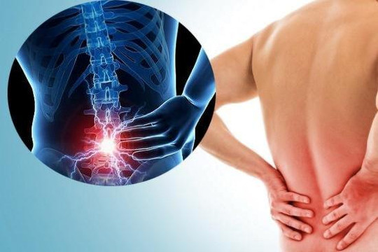 Tìm hiểu bệnh thoát vị đĩa đệm và giải pháp giúp cải thiện đau lưng  hiệu quả từ Cốt Thoái Vương