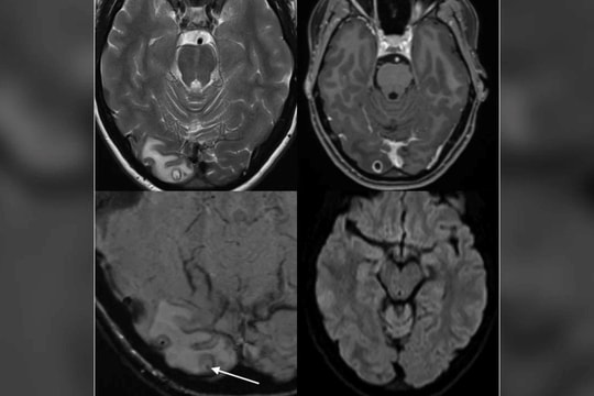 Phát hiện trường hợp nhiễm giun Ophidascaris đầu tiên ở người