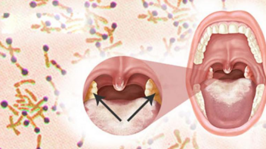 Liên tục ghi nhận các ca bệnh bạch hầu tại Hà Giang