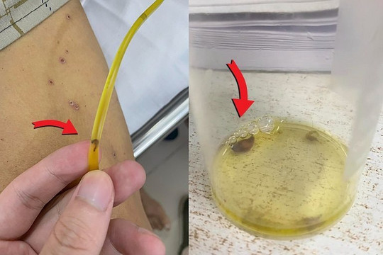 Sán lá gan chui ra từ ống dẫn lưu đường mật