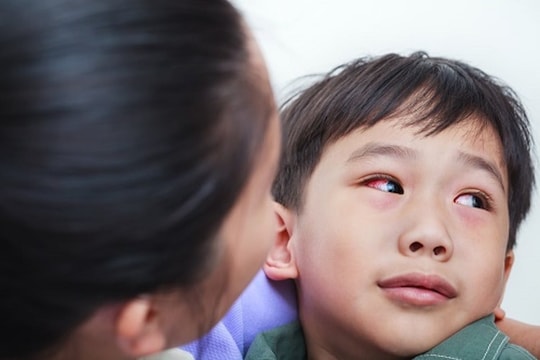 Bệnh đau mắt đỏ gia tăng, bác sĩ hướng dẫn cách điều trị