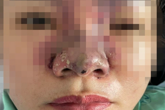 Biến chứng sau khi tiêm filler "chui" ở khách sạn