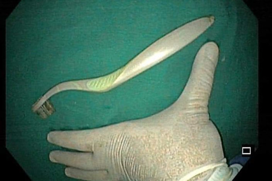 Nữ sinh nuốt bàn chải đánh răng dài 20cm vào bụng