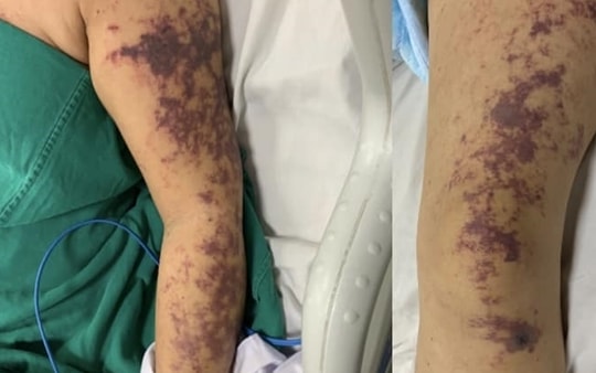 Hà Nội: Tăng ca mắc và tử vong do vi khuẩn liên cầu lợn