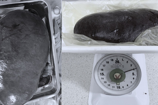 Lá lách "khủng" nặng 4kg chiếm hơn nửa ổ bụng