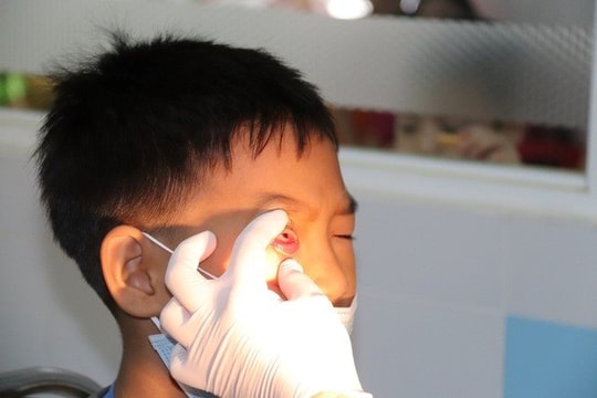 TP.HCM xác định 2 loại virus gây bệnh đau mắt đỏ cho người dân