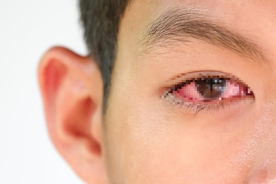 Thực hư thông tin đau mắt đỏ lây qua nước uống?