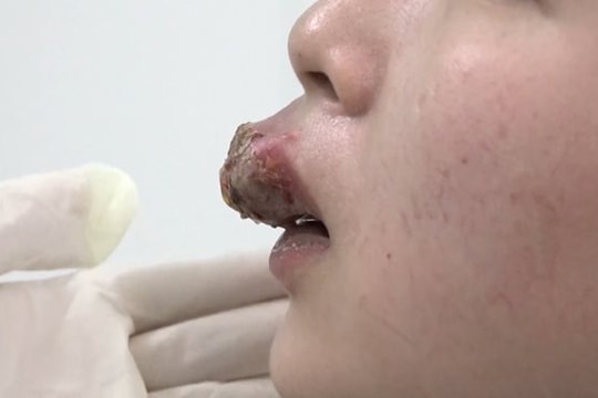Cảnh báo biến chứng nguy hiểm khi xăm môi