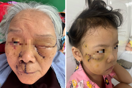 Hỏng mắt, rách má vì chó nhà tấn công