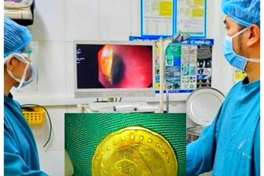 Bé gái 5 tuổi bị hóc đồng xu trong thực quản