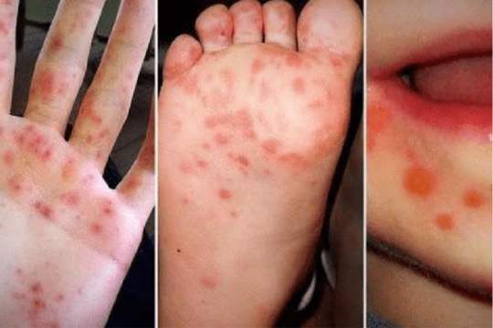 Cảnh báo bệnh tay chân miệng