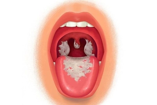 3 người tử vong vì bệnh bạch hầu, Bộ Y tế ra công văn khẩn