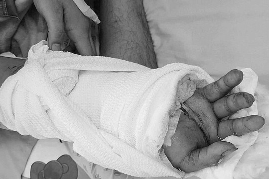 Nửa đêm vào viện với bàn tay đứt lìa được bảo quản trong thùng đá