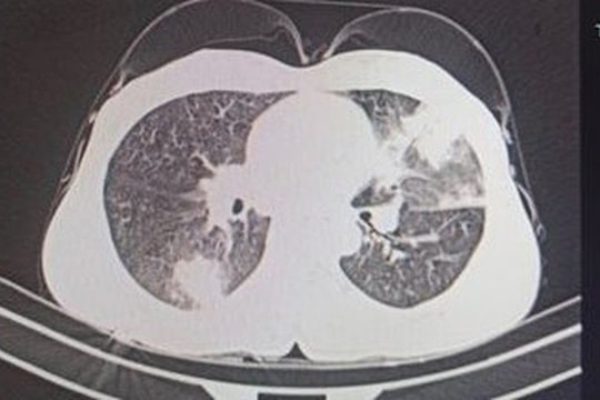 Ca viêm phổi hiếm gặp, bất ngờ nguyên nhân từ nhiễm giun đũa chó, mèo