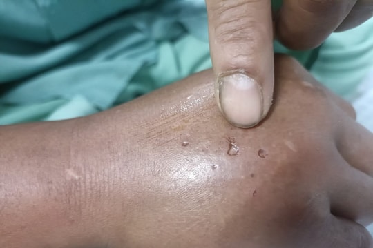 Chơi ở sân nhà, hai bé gái sinh đôi bị rắn hổ mang cắn