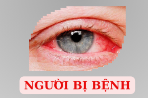 Cách phòng tránh sự lây lan của bệnh đau mắt đỏ