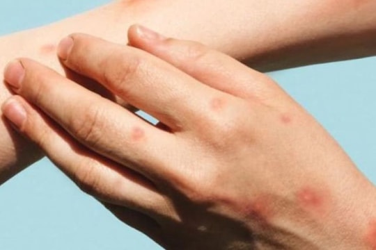 Xuất hiện ca mắc đậu mùa khỉ chưa rõ nguồn lây